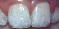 Teeth with Mild Fluorosis