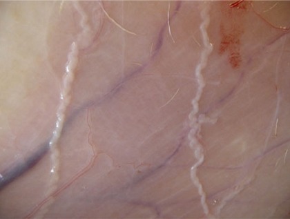 Thickened Peripheral Nerves